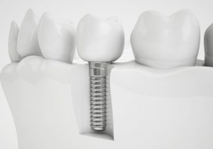 firmly fixed dental implant