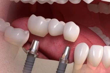 dental support bridges