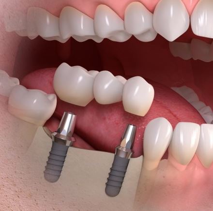 dental support bridges